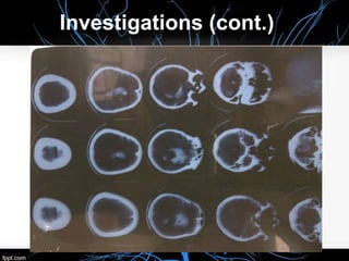 Intracerebral Hemorrhage Case presentation | PPTX