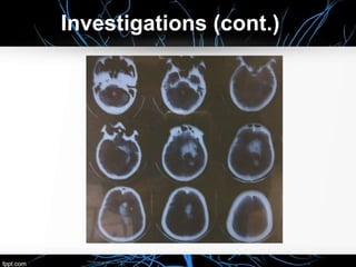 Intracerebral Hemorrhage Case presentation | PPTX