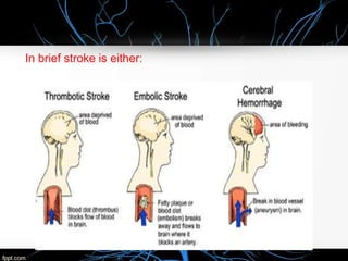 Intracerebral Hemorrhage Case presentation | PPTX