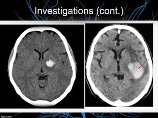 Intracerebral Hemorrhage Case presentation | PPTX