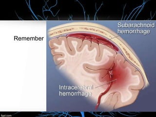 Intracerebral Hemorrhage Case presentation | PPTX
