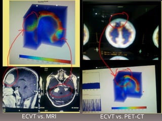 ECVT vs. PET-CTECVT vs. MRI
 