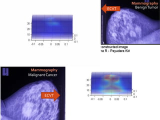 ECVT
ECVT
BenignTumor
Malignant Cancer
Mammography
Mammography
 