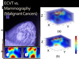ECVTvs.
Mammography
(MalignantCancers)
 