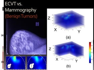 ECVTvs.
Mammography
(BenignTumors)
 
