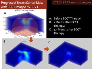 A. Before ECCTTherapy;
B. 1 Month after ECCT
Therapy;
C. 1.5 Month after ECCT
Therapy
A
B C
CTECH LABS EDWAR TECHNOLOGYProgressofBreastCancerMass
withECCTimagedbyECVT
 