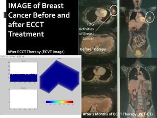 BeforeTherapy
After 2 Months of ECCTTherapy (PET-CT)
After ECCTTherapy (ECVT Image)
FDG
Activities
of Breast
Cancer
IMAGE of Breast
Cancer Before and
after ECCT
Treatment
 