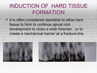INDUCTION OF HARD TISSUE
FORMATION
 It is often considered desirable to allow hard
tissue to form to continue apical root
development to close a wide foramen , or to
create a mechanical barrier at a fracture line.
 