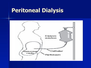 Peritoneal Dialysis
 