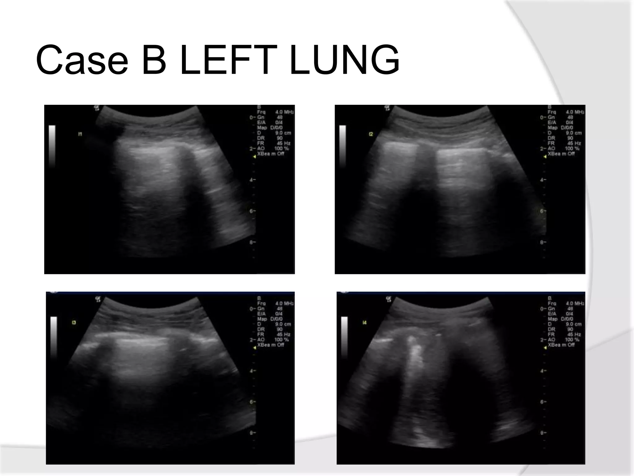The Basics of Lung Ultrasound | PPTX
