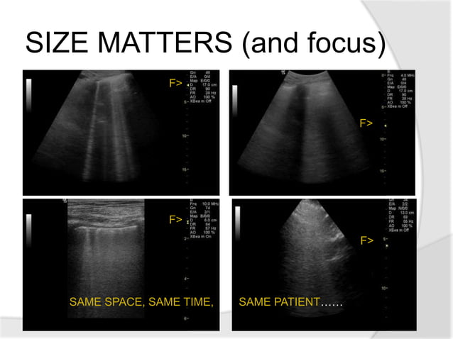 The Basics of Lung Ultrasound | PPTX