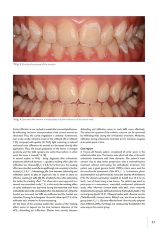 17
• Fig. 3: Directly after removal of the brackets.
• Fig. 4: One week after removal of the brackets and after inﬁltration of the control teeth.
Caries infiltration is one method to mask initial non-cavitated lesions.
By infiltrating the lesion microporosities of the carious enamel are
obturated. Thus, the caries progression is arrested. Furthermore,
due to the similar refractive index of the infiltrant (RI of infiltrant
1.52) compared with apatite (RI=1.62), light scattering is reduced
and visual color differences to enamel are decreased directly after
application. Thus, the visual appearance of the lesion is changed
positively and the WSL appears less white than before; in other
word: the lesion is masked [10, 14].
In several studies on WSL - being diagnosed after orthodontic
treatment with fixed elements - a positive masking effect after the
infiltration was observed [3, 4, 5, 6, 8, 9]. Furthermore, the masking
effectwasclassifiedassatisfactory(althoughnotcomplete)infurther
studies [4, 5, 8, 11]. Interestingly, the time between debonding and
infiltration seems to play an important role in order to allow an
effective masking of WSL [9]. The shorter the time after debonding
the better the masking effect. This observation was supported in a
second non-controlled study [13]. In this study the masking effect
of caries infiltration was examined during the treatment with fixed
orthodontic elements. Immediately after the detection of a WSL the
bracket was removed, the WSL was infiltrated and the bracket was
rebonded. During the subsequent 10-month follow-up 92.5 % of the
infiltrated WSL showed no further worsening.
On the basis of the previous studies the success of the masking
effect seems to depend on the time between detection of the
WSL, debonding and infiltration. Shorter time periods between
debonding and infiltration seem to mask WSL more effectively.
This raises the question if the esthetic outcome can be optimized
by infiltrating WSL during the orthodontic treatment. Moreover,
infiltration during orthodontic treatment arrests the lesion progress
at an earlier point in time.
Case report
A 15-year-old female patient complained of white spots in the
esthetical visible area. The lesions were observed after a 24-month
orthodontic treatment with fixed elements. The patient’s main
concern was to stop lesion progression with a minimal-invasive
treatment without interrupting the orthodontic treatment. The
patient was in good general health. ICDAS criteria were used for
the visual-tactile assessment of the WSL [11]. Furthermore, photo
documentation was performed to assess the severity of the lesions
[19]. The clinical examination revealed an ICDAS level of 2 for six
teeth , two of these being active lesions. The patient was asked to
participate in a monocentric, controlled, randomized split-mouth
study. After informed consent teeth with WSL were randomly
divided into two groups. Without removing the brackets, teeth in the
control group (teeth 13, 21, 23) were treated with a fluoride varnish
(Tiefenfluorid®, Humanchemie, Alfeld/Leine) and those in the test
group (teeth 12, 11, 22) were infiltrated with a low-viscosity polymer
(Icon-Infiltrant, DMG, Hamburg) and subsequently fluoridated in the
same way as the control group.
 