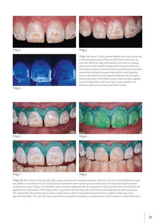 31
• Fig. 2
• Fig. 4
• Fig. 3
• Fig. 1-4: Figures 1, 2 and 3 present different views of the clinical case
in which the patient presents ﬂuorosis (TF6). Observe that there are
areas with diffuse and slight white opacities, areas with very opaque
white opacities and areas that already present enamel loss and some
discoloration. In Figure 4 transillumination was performed to check light
transmittance through the enamel, that may be a useful diagnostic
tool since the deeper the enamel hypomineralization, the more light is
blocked. Some areas of the affected anterior teeth area were suggested
to present deeper lesions, that may impair a more complete resin
inﬁltration without some previous wear of the enamel.
• Fig. 5
• Fig. 7
• Fig. 6
• Fig. 8
• Fig. 5-8: After isolation of the operatory ﬁeld using lip retractors and a liquid dam to protect soft tissues (Fig. 5), Icon-Etch (hydrochloric acid)
was applied on the surfaces for 2 mins (Fig. 6) aiming to remove the enamel surface layer and create access to the subsurface hypomineralized
enamel (porous area). In Figure 7 it is possible to observe the matt appearance after the acid etching. In Figure 8, a drop of Icon-Dry (alcohol) was
applied on the etched surfaces. After a few seconds, it is possible to see that some areas around the enamel pitting kept very white and opaque.
This »optical test« after etching may be useful to indicate areas in which a more pronounced enamel wear is needed to create access to the
hypomineralized layer. This extra step may be performed with repeated acid etchings or, in deeper lesions, with air abrasion or rotary instruments.
 