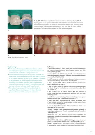 75
Key Learnings
• In the deep infiltration protocol the external lesion surface
should be previously removed using mechanical abrasion with
aluminum oxide sandblast or a rotary diamond bur.
• Transillumination technique can be very useful to identify the
depth of the lesion. When a light uniform blue aspect is noticed
in the baseline analysis of the clinical case, the lesion is supposed
to be shallow, and the regular superficial infiltration can be
attempted first However, when dark blue or black areas are
observed in the center of the lesion, it is considered deep, and
the deep infiltration technique should be performed.
• The esthetic treatments of MIH may combined with the
superficial infiltration technique and the deep infiltration
procedure followed with the composite restoration.
• Fig. 9 A-D: Next, the deep inﬁltrated lesions were restored with composite (Fig. 9 A). A
layer of glycerin gel was applied over the whole inﬁltrated teeth surface in order to eliminate the
environmental oxygen, which can inhibit cure of the external inﬁltrated layer, providing a better
conversion degree of the monomers in polymers (Fig. 9 B). After that, the surface was ﬁrst
polished with abrasive disks and then with felt disks and polishing paste.
• Fig. 10 A-B: Post-treatment results.
A B
References
1. Denis M, Atlan A, Vennat E, Tirlet G, Attal JP. White defects on enamel: diagnosis
and anatomopathology: two essential factors for proper treatment (part 1). Int
Orthod 2013;11(2):139-65.
2.RobinsonC,HallsworthAS,WeatherellJA,KunzelW.Arrestandcontrolofcarious
lesions: a study based on preliminary experiments with resorcinol-formaldehyde
resin. J Dent Res 1976;55(5):812-8.
3. Croll TP. Bonded resin sealant for smooth surface enamel defects: new concepts in
"microrestorative" dentistry. Quintessence Int 1987;18(1):5-10.
4. Paris S, Meyer-Lueckel H, Kielbassa AM. Resin inﬁltration of natural caries
lesions. J Dent Res 2007;86(7):662-6.
5. Torres CR, Rosa PC, Ferreira NS, Borges AB. Effect of caries inﬁltration technique
and ﬂuoride therapy on microhardness of enamel carious lesions. Oper Dent
2012;37(4):363-9.
6. Paris S, Meyer-Lueckel H, Colfen H, Kielbassa AM. Resin inﬁltration of
artiﬁcial enamel caries lesions with experimental light curing resins. Dent Mater
J 2007;26(4):582-8.
7. Paris S, Meyer-Lueckel H. Masking of labial enamel white spot lesions by resin
inﬁltration--a clinical report. Quintessence Int 2009;40(9):713-8.
8. Rocha Gomes Torres C, Borges AB, Torres LM, Gomes IS, de Oliveira RS. Effect
of caries inﬁltration technique and ﬂuoride therapy on the colour masking of white
spot lesions. J Dent 2011;39(3):202-7.
9. Torres CR, Borges AB. Color masking of developmental enamel defects: a case
series. Oper Dent 2015;40(1):25-33.
10. Jalevik B, Noren JG. Enamel hypomineralization of permanent ﬁrst molars: a
morphological study and survey of possible aetiological factors. Int J Paediatr Dent
2000;10(4):278-89.
11. Johnsen D, Krejci C, Hack M, Fanaroff A. Distribution of enamel defects and
the association with respiratory distress in very low birthweight infants. J Dent Res
1984;63(1):59-64.
12. Attal JP, Atlan A, Denis M, Vennat E, Tirlet G. White spots on enamel: treatment
protocol by superﬁcial or deep inﬁltration (part 2). Int Orthod 2014;12(1):1-31.
13. Abts C, Konietzke J, Ehrlich E, Fritz U, Meyer-Lueckel H. Case Series on the Value
of Re-Wetting Prior to Resin-Inﬁltration of Caries Lesions. Caries Res 2014;48:1.
D
 