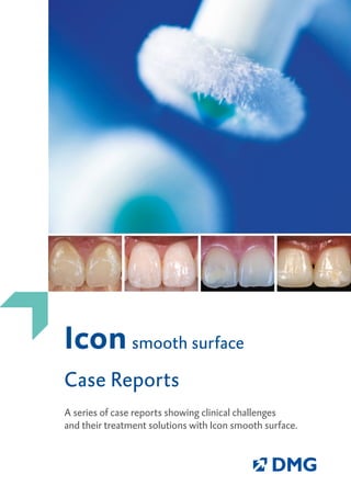 Icon smooth surface
Case Reports
A series of case reports showing clinical challenges
and their treatment solutions with Icon smooth surface.
 