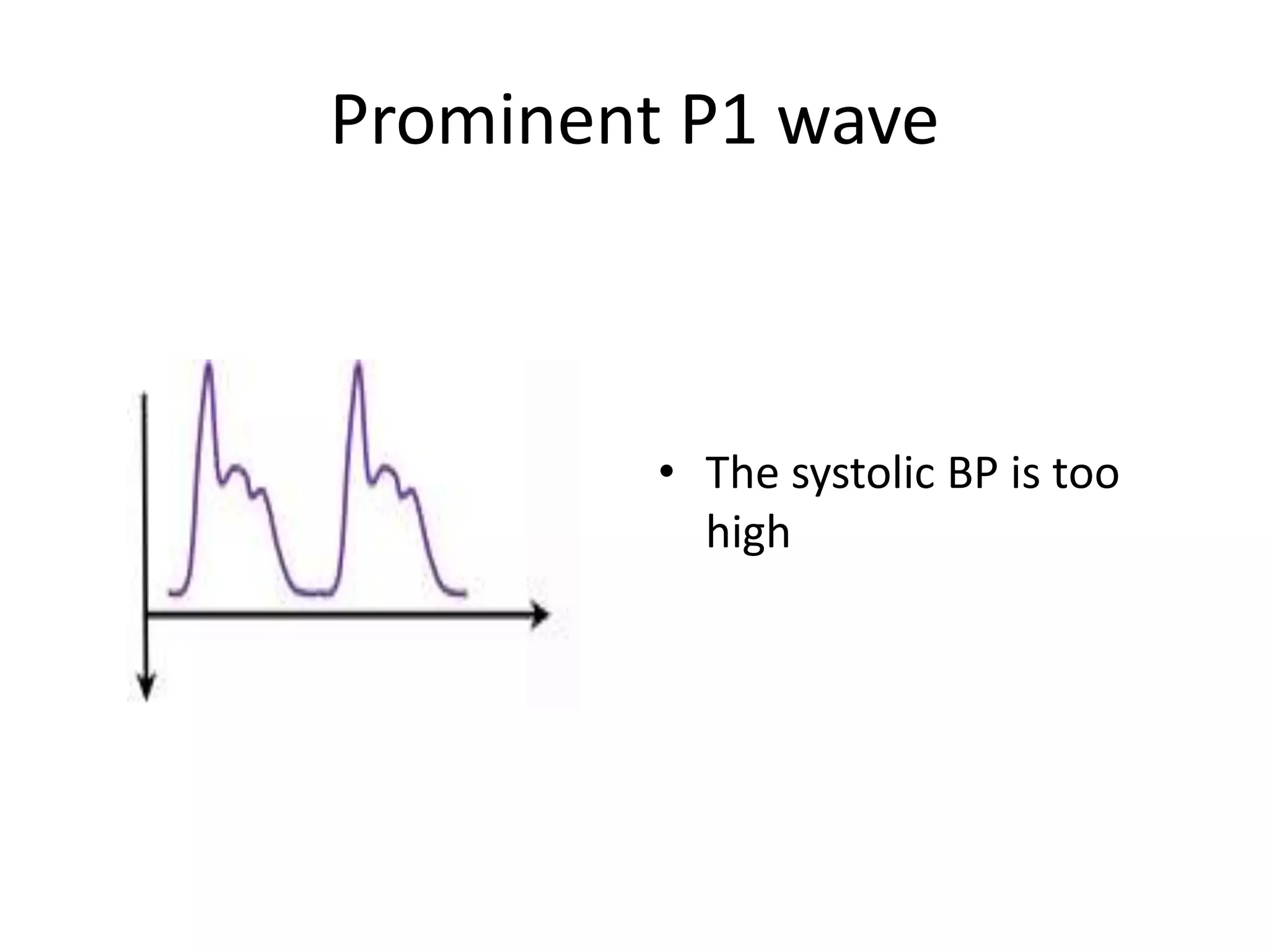 Prominent P1 wave

• The systolic BP is too
high

 