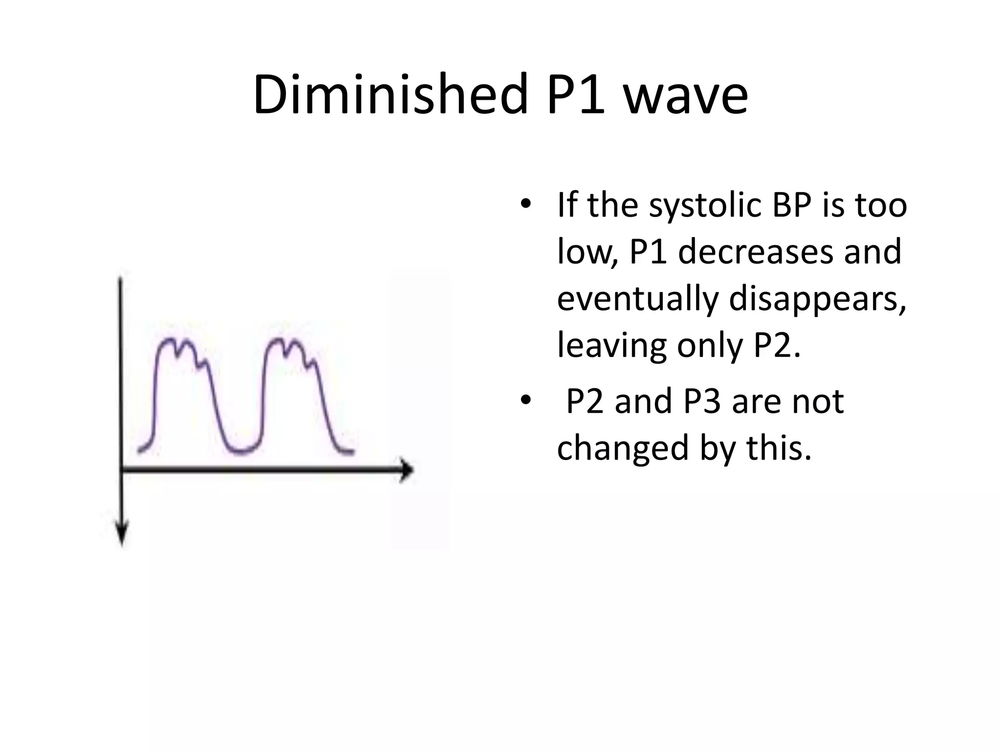 Diminished P1 wave
• If the systolic BP is too
low, P1 decreases and
eventually disappears,
leaving only P2.
• P2 and P3 are not
changed by this.

 