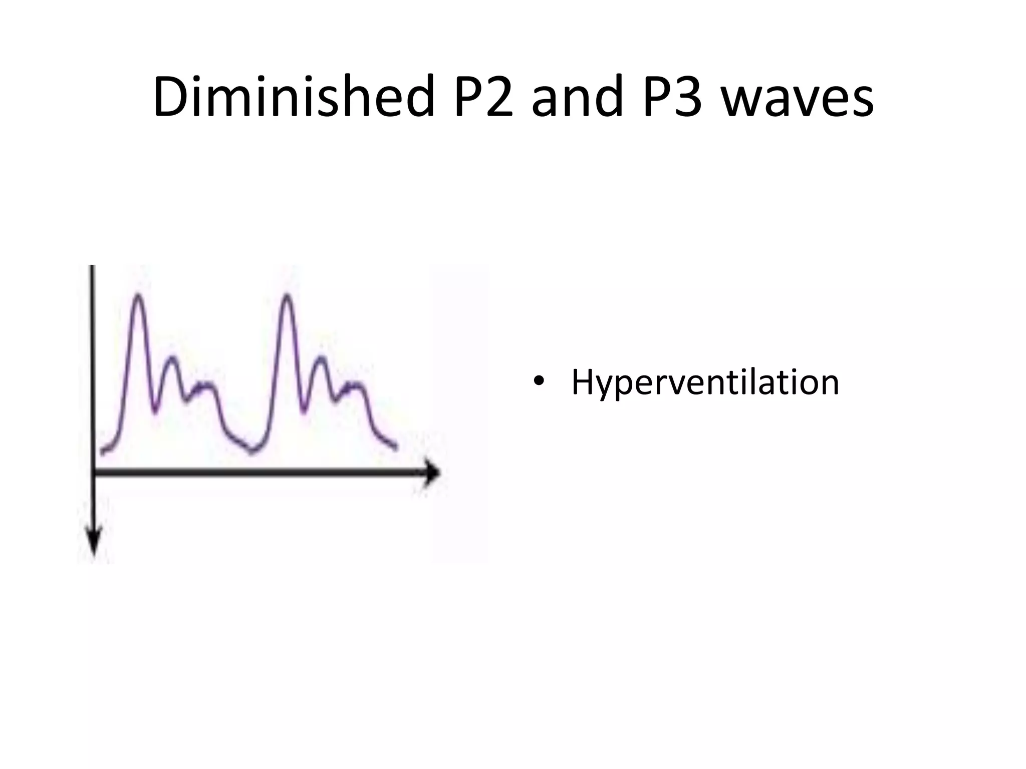 Diminished P2 and P3 waves

• Hyperventilation

 