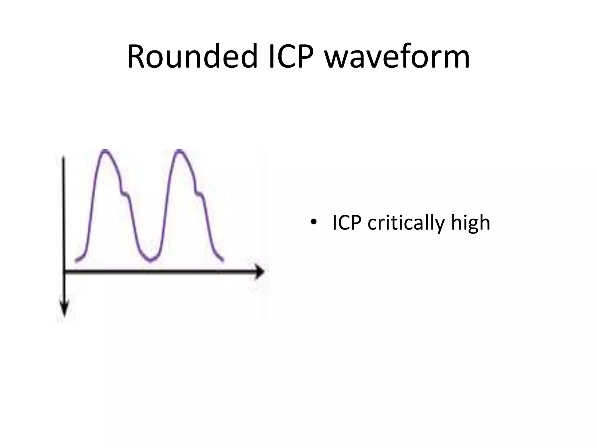 Rounded ICP waveform

• ICP critically high

 