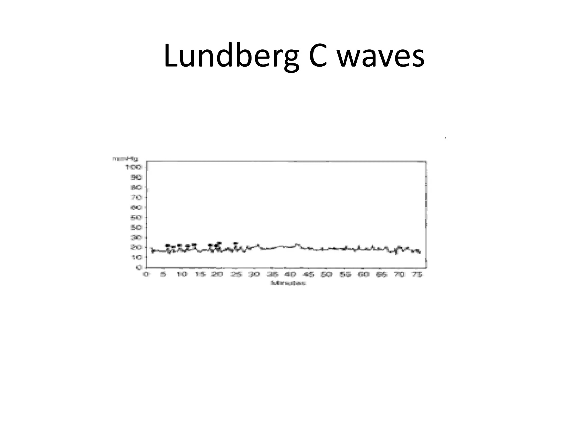 Lundberg C waves

 