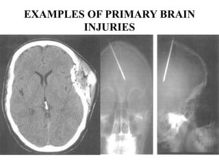 EXAMPLES OF PRIMARY BRAIN
INJURIES

 