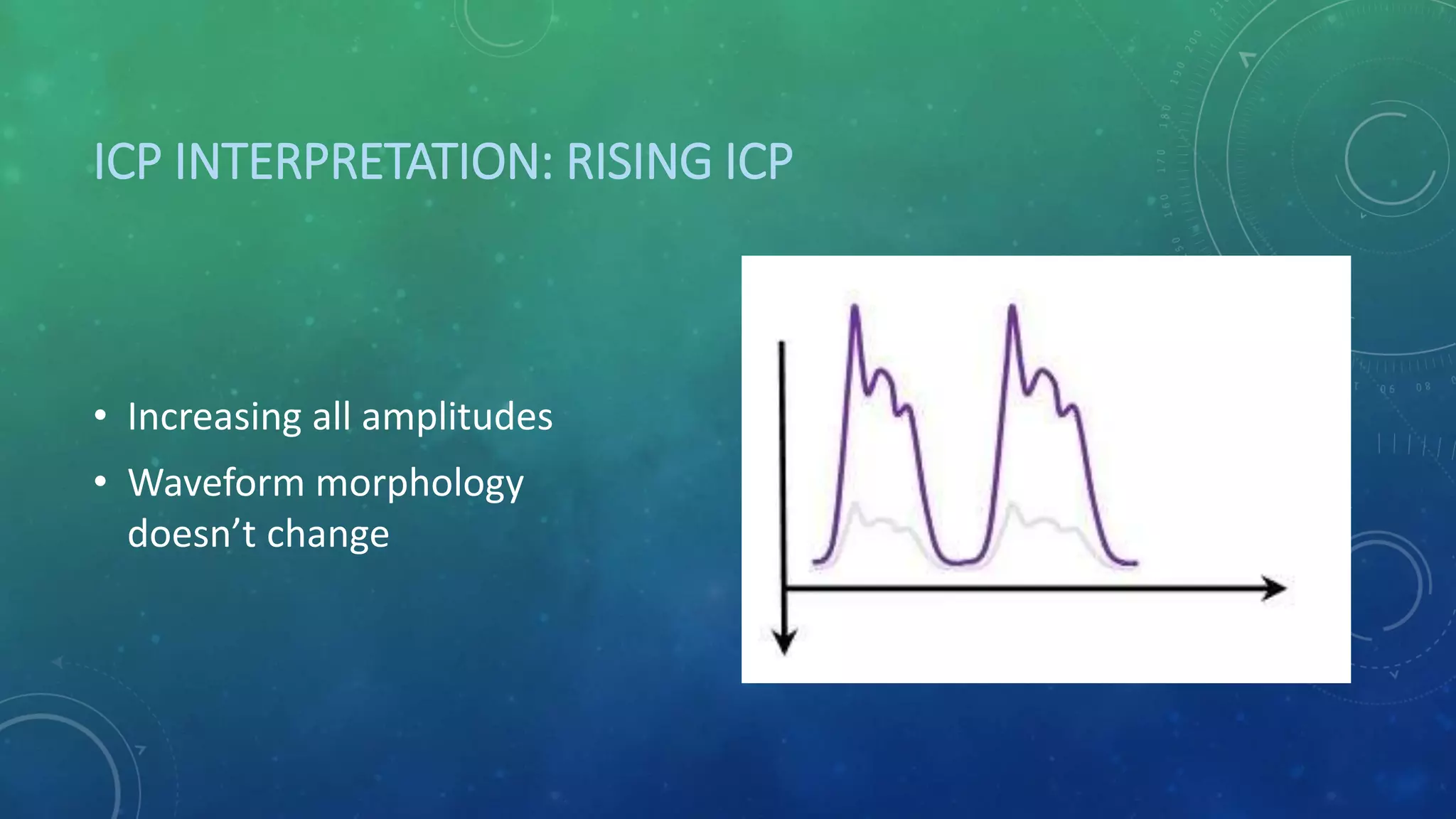 ICP INTERPRETATION: RISING ICP
• Increasing all amplitudes
• Waveform morphology
doesn’t change
 