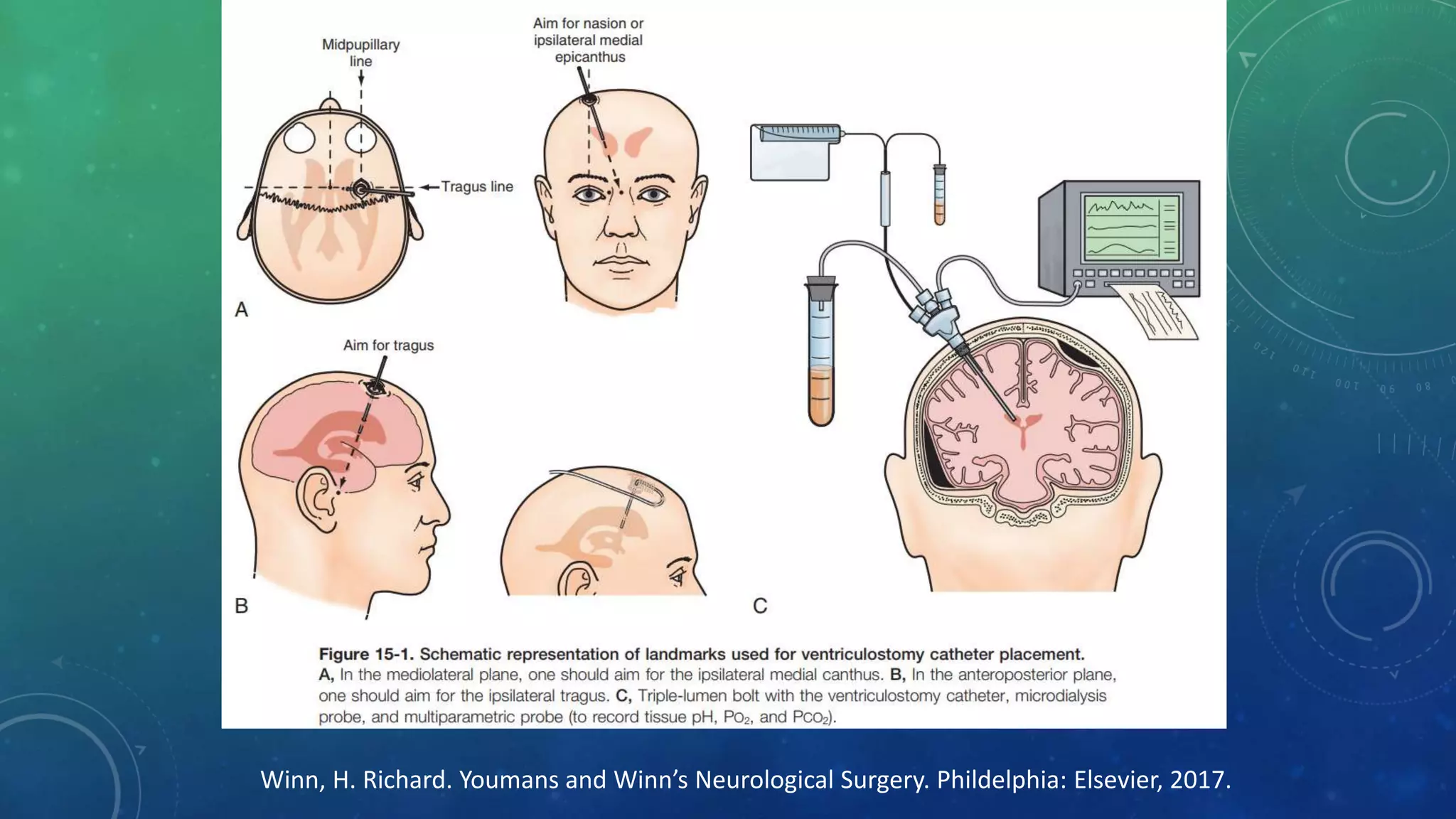 Winn, H. Richard. Youmans and Winn’s Neurological Surgery. Phildelphia: Elsevier, 2017.
 