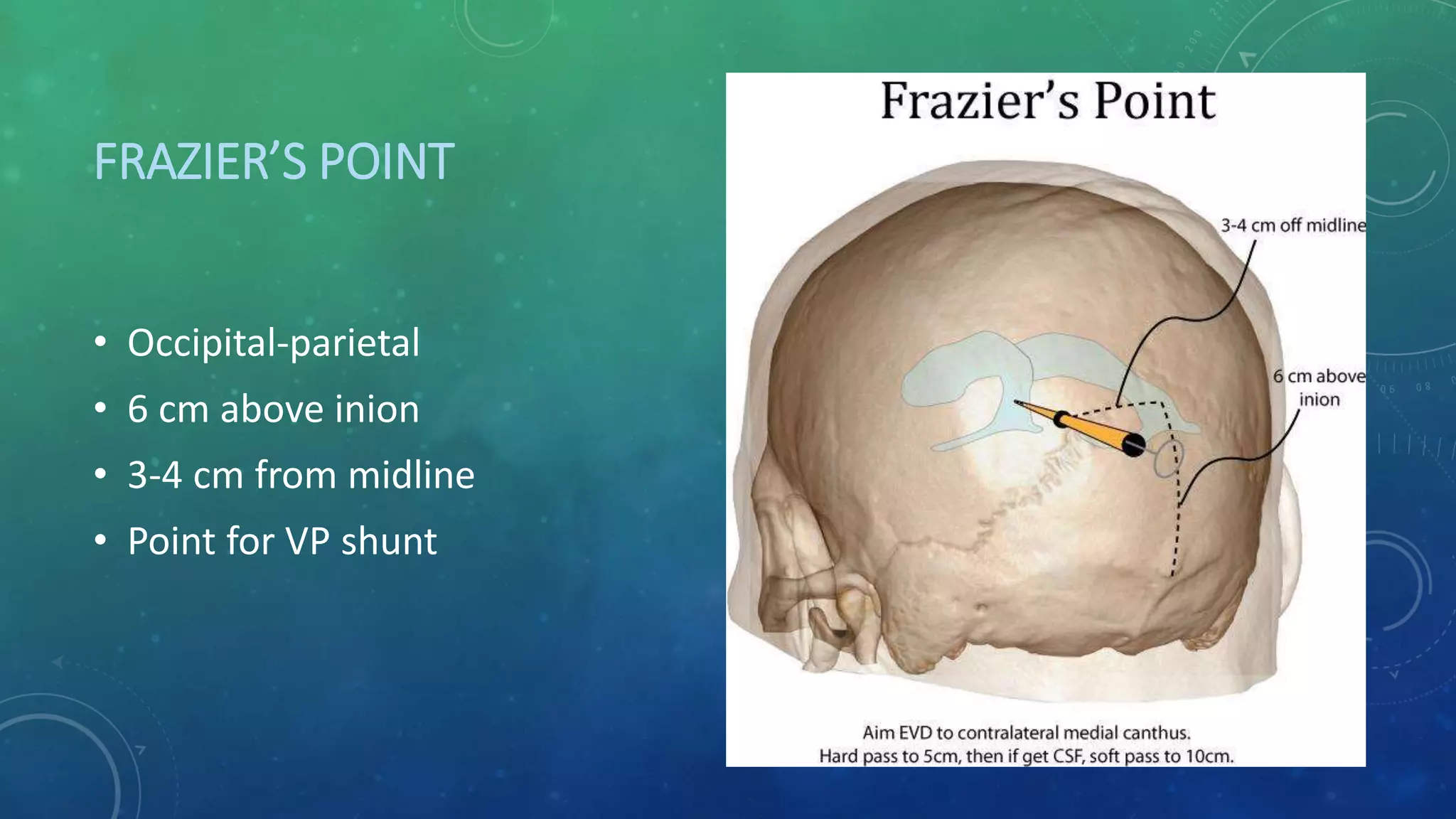 FRAZIER’S POINT
• Occipital-parietal
• 6 cm above inion
• 3-4 cm from midline
• Point for VP shunt
 