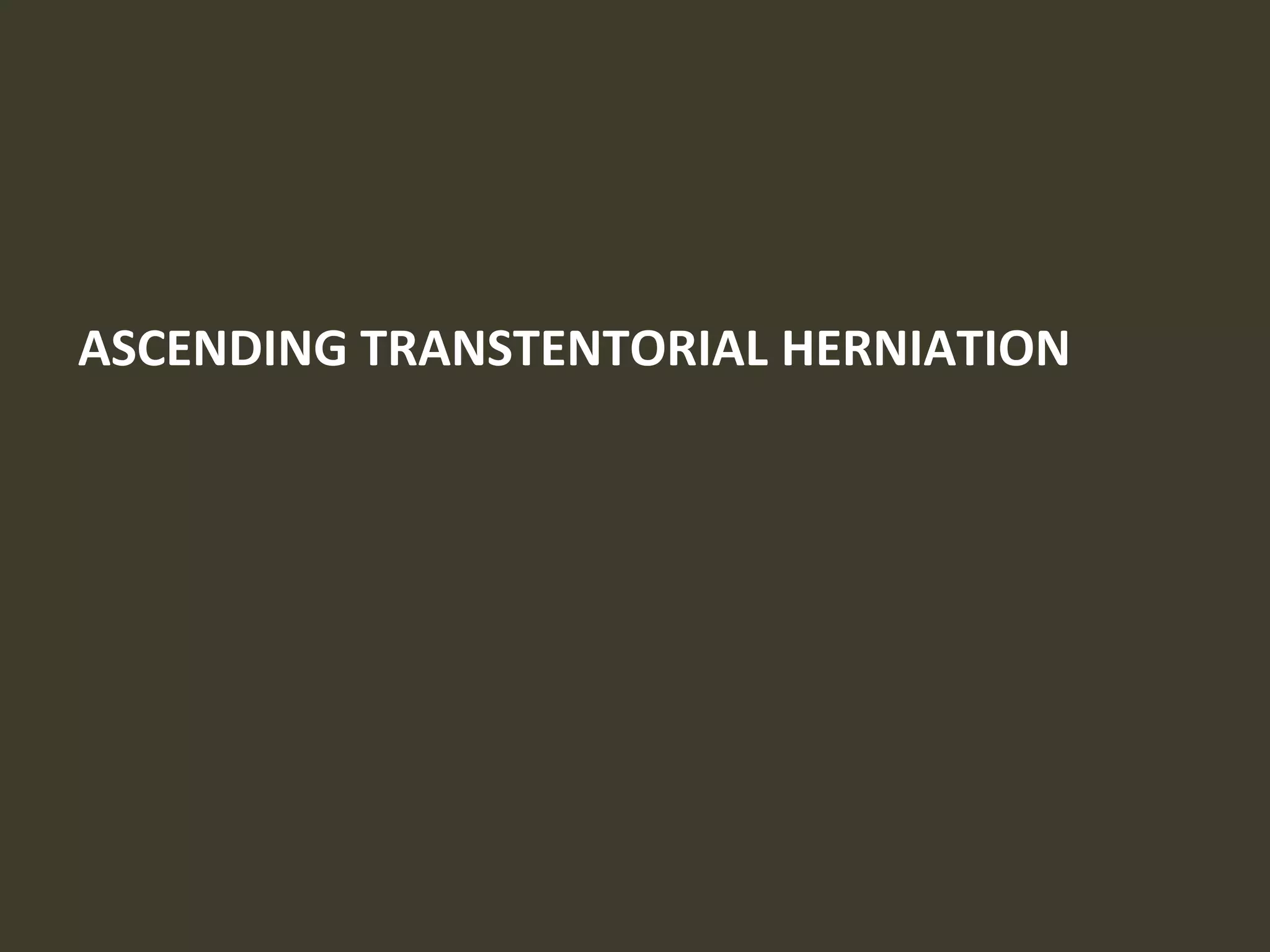 ASCENDING TRANSTENTORIAL HERNIATION
 