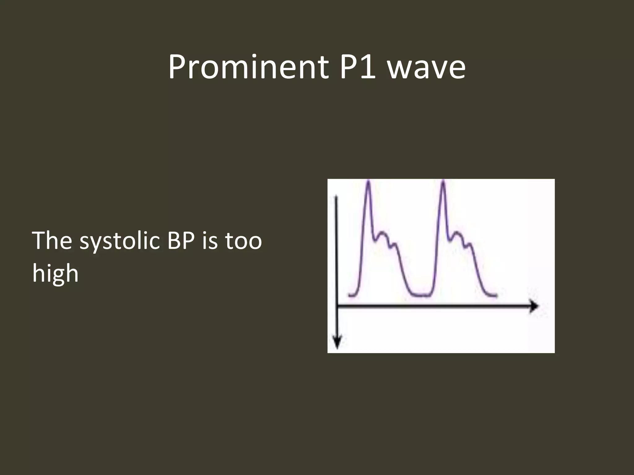 Prominent P1 wave
The systolic BP is too
high
 