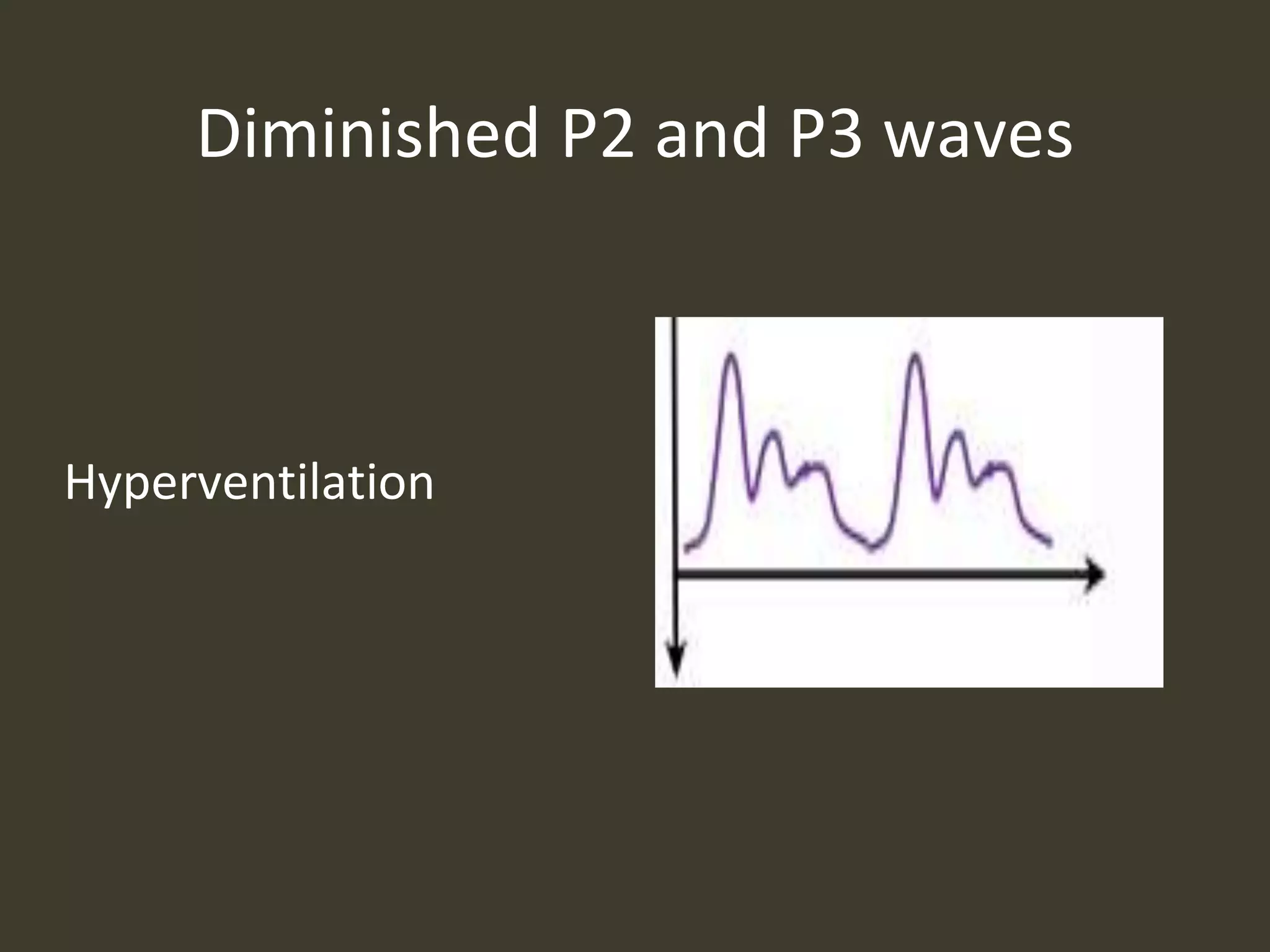 Diminished P2 and P3 waves
Hyperventilation
 
