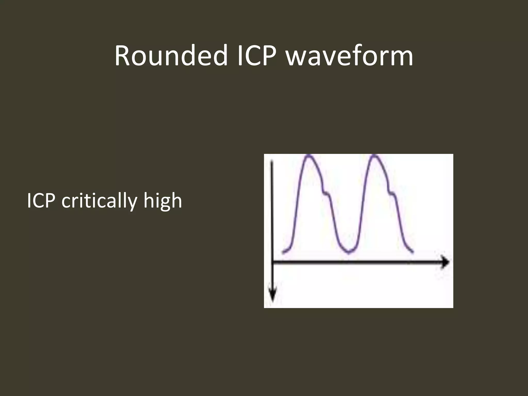 Rounded ICP waveform
ICP critically high
 
