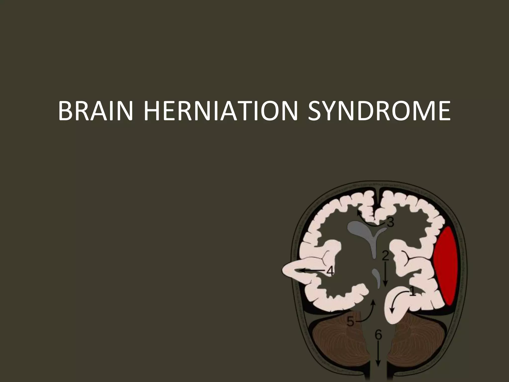 BRAIN HERNIATION SYNDROME
 