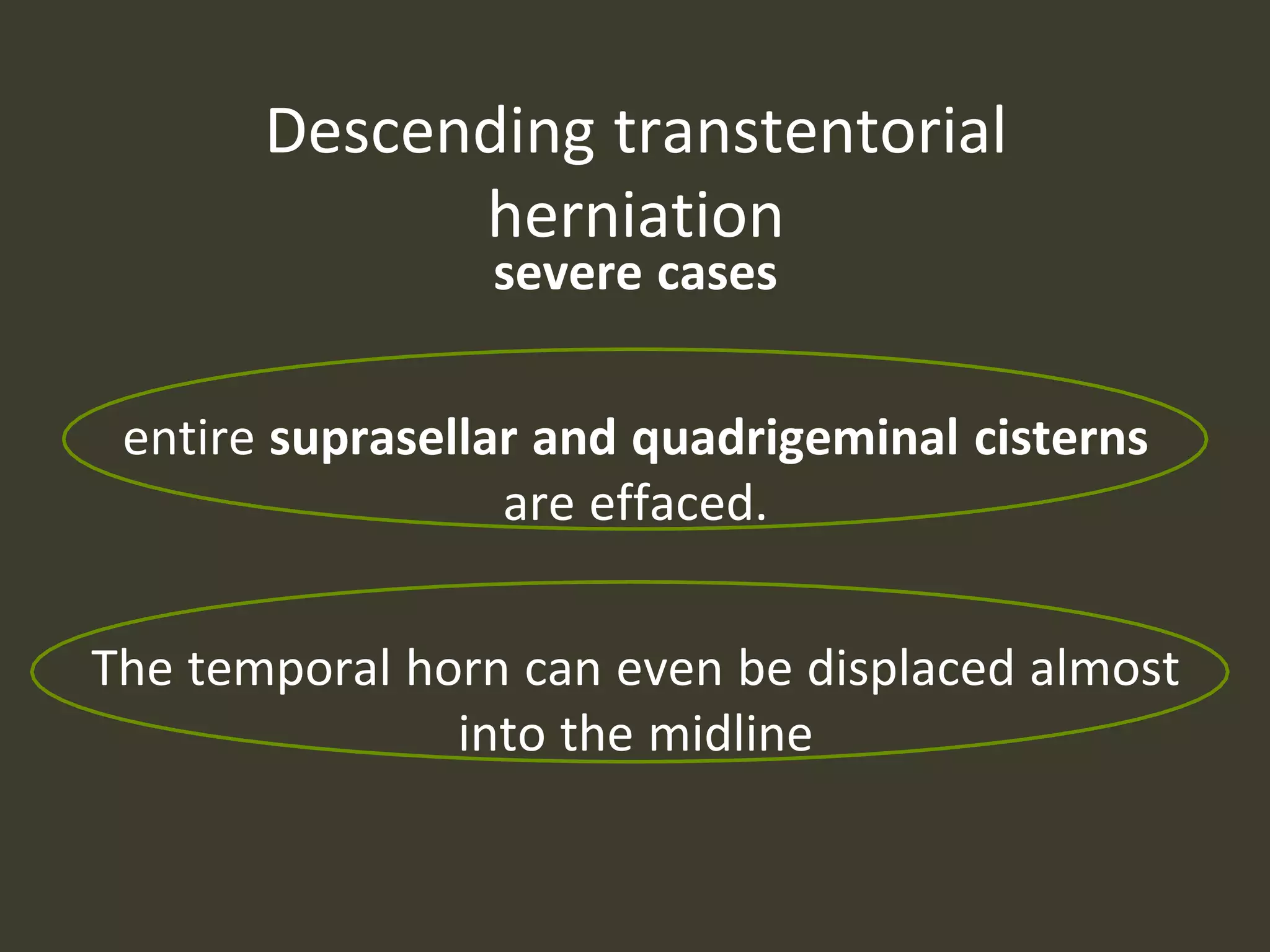 Descending transtentorial
herniation
severe cases
entire suprasellar and quadrigeminal cisterns
are effaced.
The temporal horn can even be displaced almost
into the midline
 