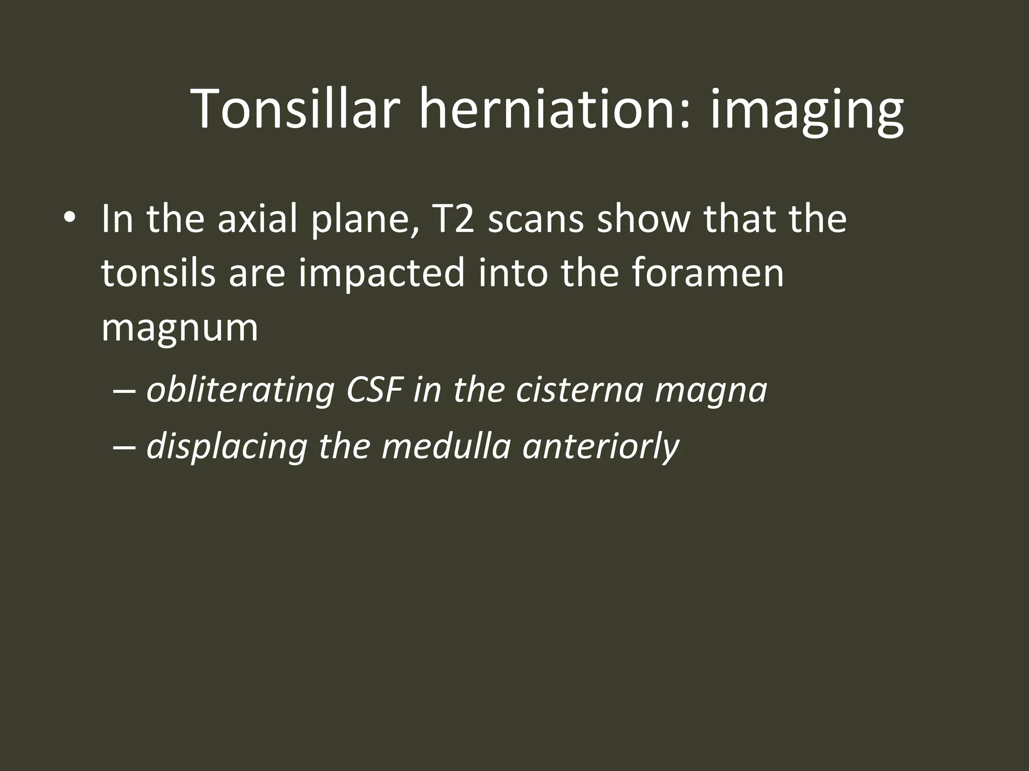 Tonsillar herniation: imaging
• In the axial plane, T2 scans show that the
tonsils are impacted into the foramen
magnum
– obliterating CSF in the cisterna magna
– displacing the medulla anteriorly
 