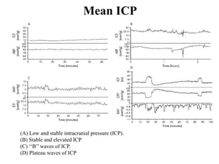 Different Icp Waveforms Icp monitoring seminar | PPTX