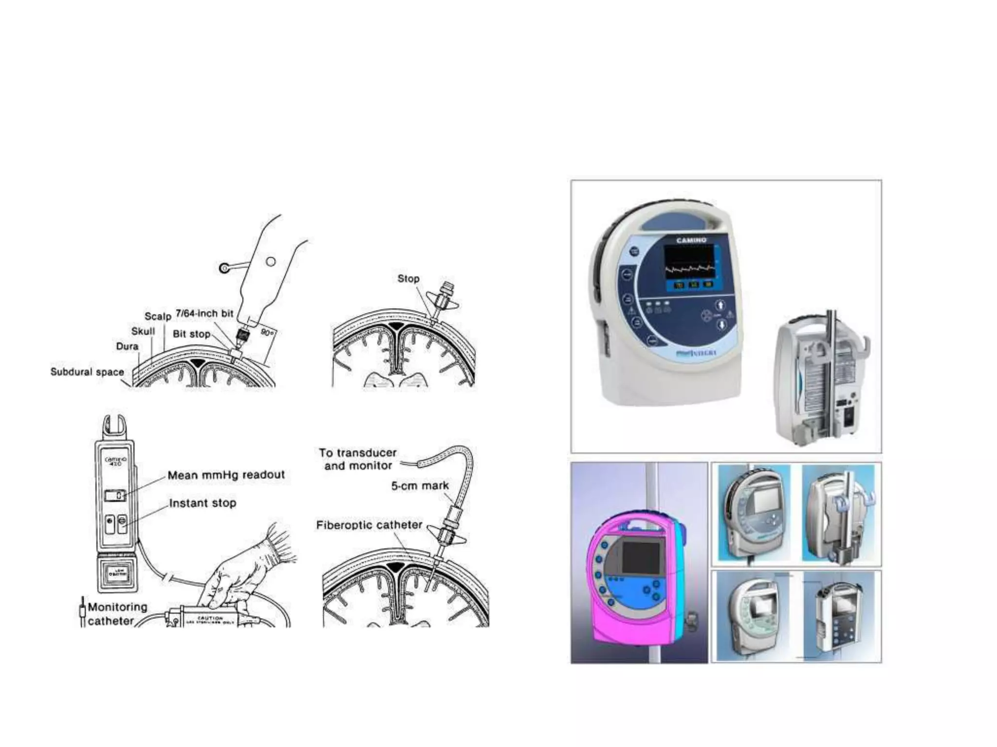 intracranial pressure monitoring | PPTX