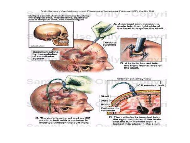 Intracranial Pressure Monitoring