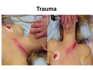 Trauma
 