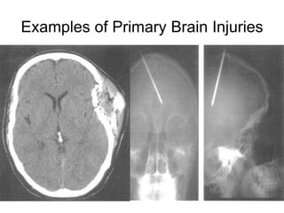Examples of Primary Brain Injuries
 