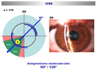 Astigmatismo moderado-alto 90º / 120º OD OD 45º 32% 11% n = 179 ICRS 3 