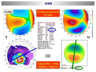 514063 Ectasia pericentral 3-5 mm Topografía - Astig. Oblicuo / Directo ICRS 