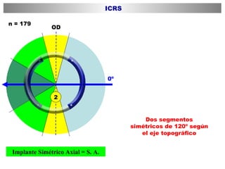 Dos segmentos simétricos de 120º según el eje topográfico OD 0º n = 179 Implante Simétrico Axial = S. A. ICRS 2 