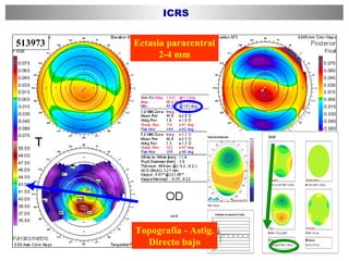 513973 Ectasia paracentral 2-4 mm Topografía - Astig. Directo bajo ICRS 