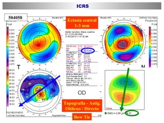 504058  ICRS Ectasia central 1-3 mm Bow Tie Topografía - Astig. Oblícuo / Directo 