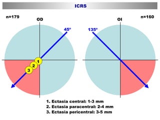 1. Ectasia central: 1-3 mm 2. Ectasia paracentral: 2-4 mm 3. Ectasia pericentral: 3-5 mm 135º 45º OD OI n=179 n=160 ICRS 1 2 3 