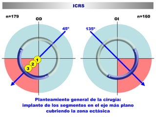 Planteamiento general de la cirugía: implante de los segmentos en el eje más plano cubriendo la zona ectásica 135º 45º OD OI n=179 n=160 ICRS 1 2 3 