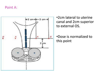 Point A:
•2cm lateral to uterine
canal and 2cm superior
to external OS.
•Dose is normalized to
this point
 