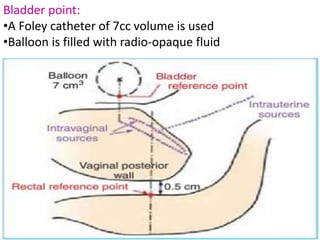 Bladder point:
•A Foley catheter of 7cc volume is used
•Balloon is filled with radio-opaque fluid
 