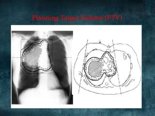 Planning Target Volume (PTV)
 